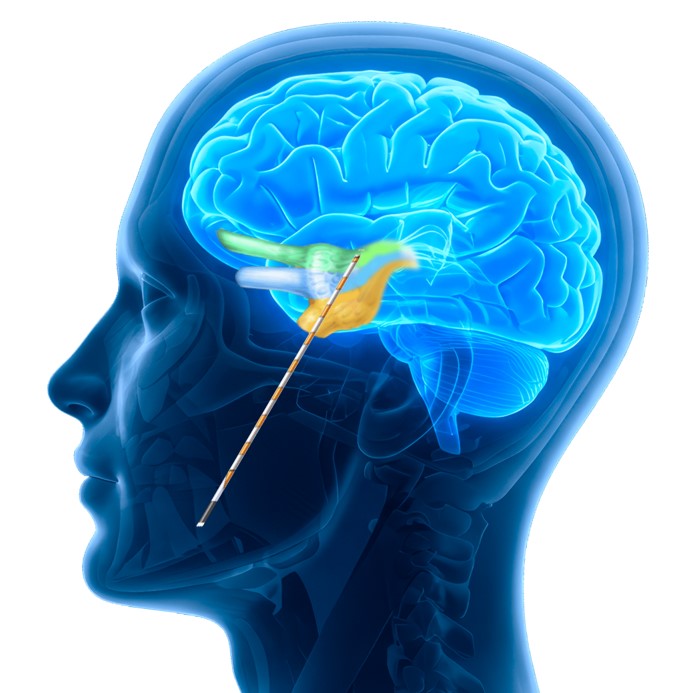 UH is first health system in the world to successfully treat patients with the OneRF Trigeminal Nerve Ablation System