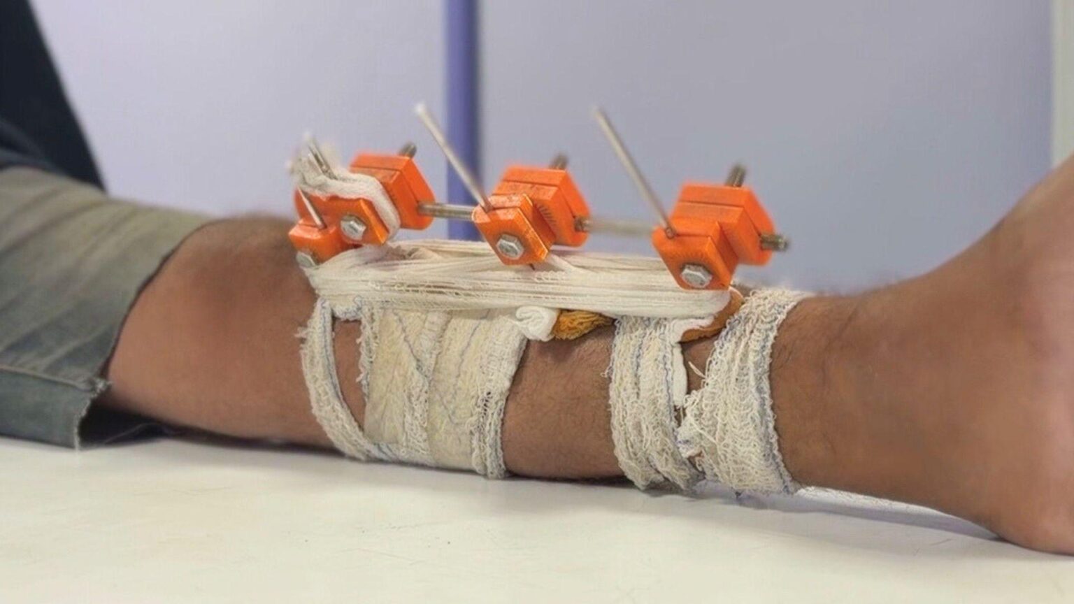 Gaza doctors use 3D tech to save limbs shattered by Israel from amputation