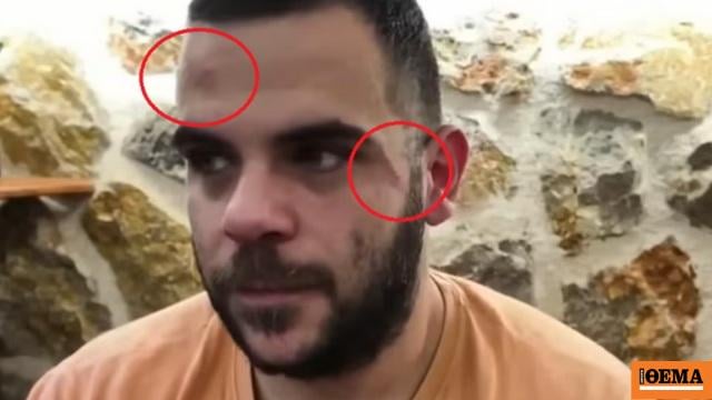 Youtuber was brutally beaten during a live broadcast in Ioannina: He was beaten in the body and face, he appeared with bruises