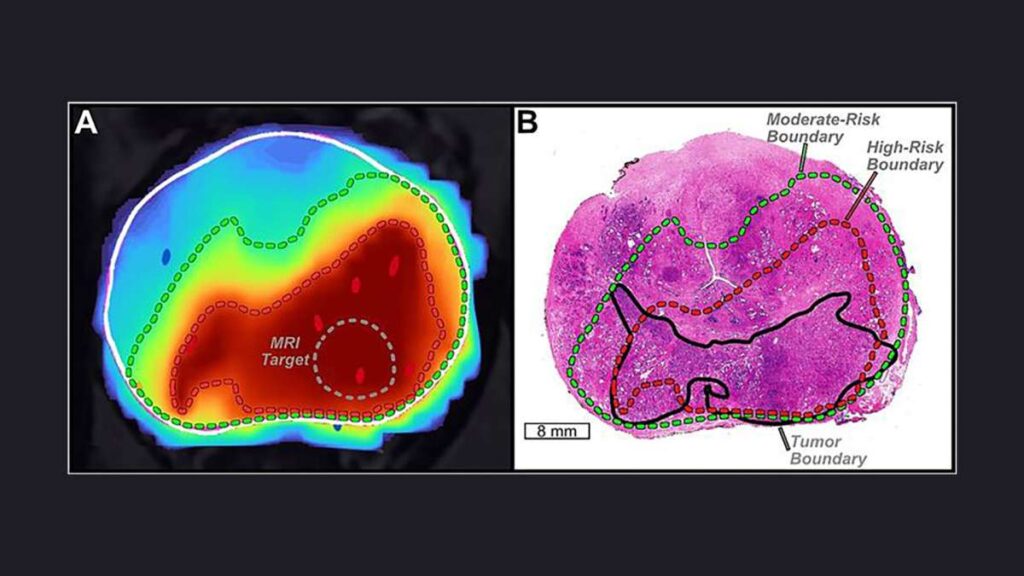 AI is helping doctors see prostate cancer more clearly and guide more effective treatments