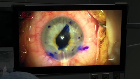 30 cornea transplants in 2025