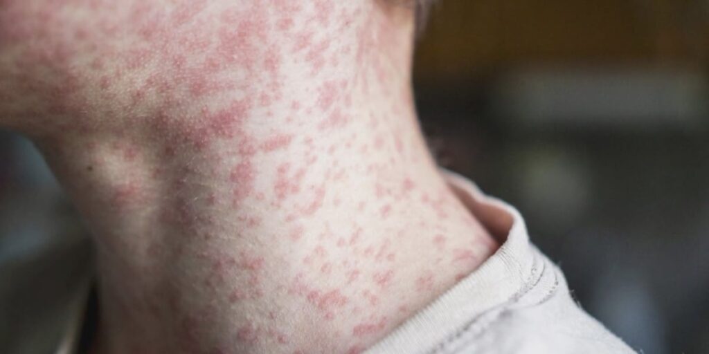 2 measles cases confirmed in Mecklenburg County, including unvaccinated child, health officials say