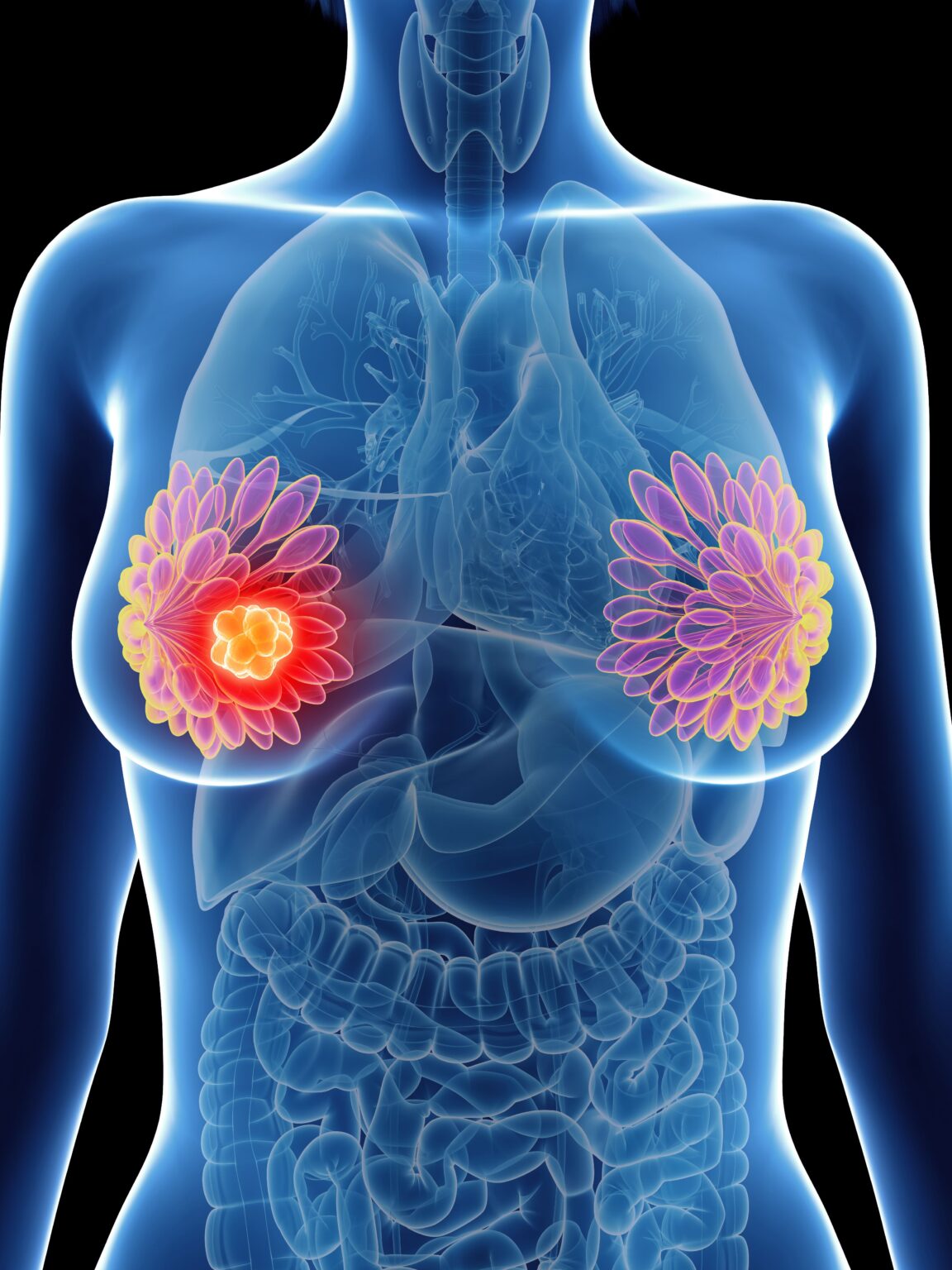 Safety data from the phase 1 LUMMICAR study 1 show no high-grade CRS or any-grade ICANS among patients with myeloma who received zevorcabtagene autoleucel.