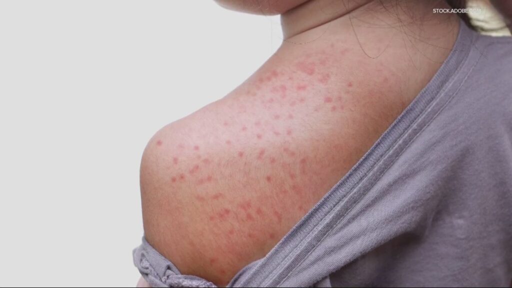 Oregon health officials confirm second measles case in Clackamas County