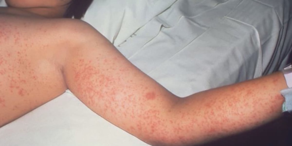 Mecklenburg health officials discuss measles safety, concerns