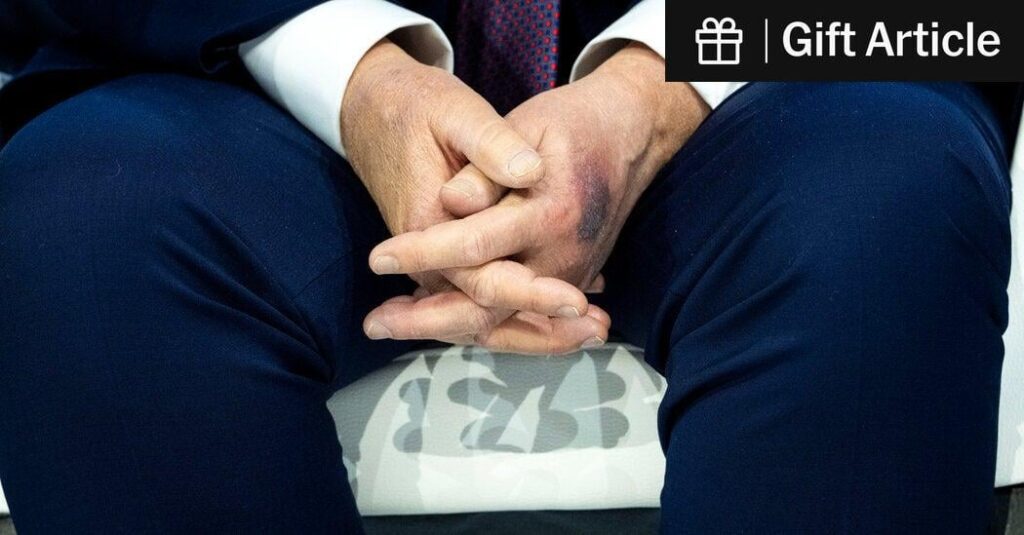 Trump Says He Bruised His Hand on a Table
