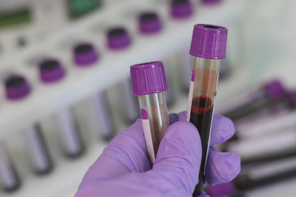 A simple blood test can help detect cancer in patients with non-specific symptoms such as fatigue, pain or weight loss, thanks to a protein signature that could be linked to a cancer diagnosis