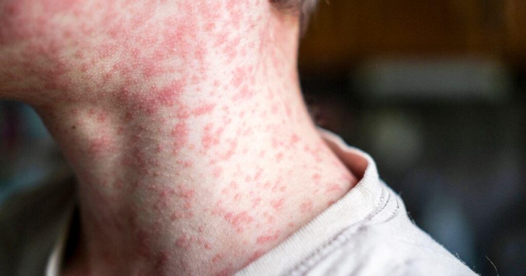 UK loses measles elimination status, WHO confirms
