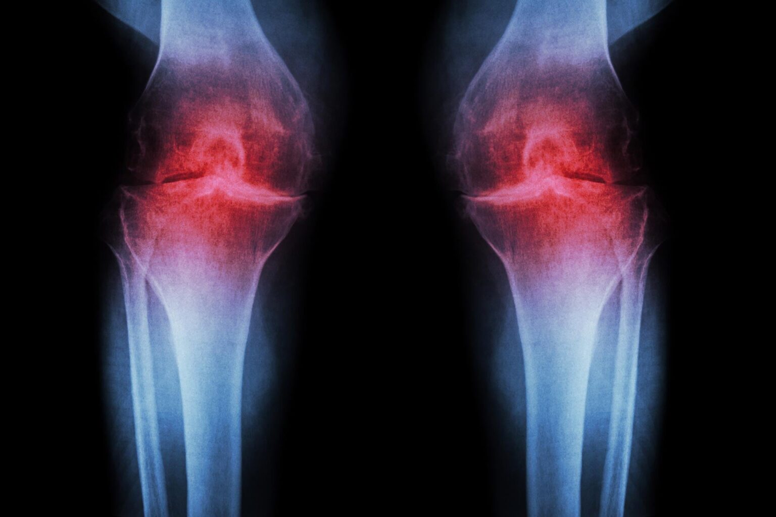 Anti-Aging Injection Regrows Knee Cartilage and Prevents Arthritis