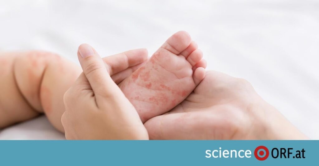 WHO: Austria is no longer officially “measles-free” WHO: Austria is no longer officially “measles-free”