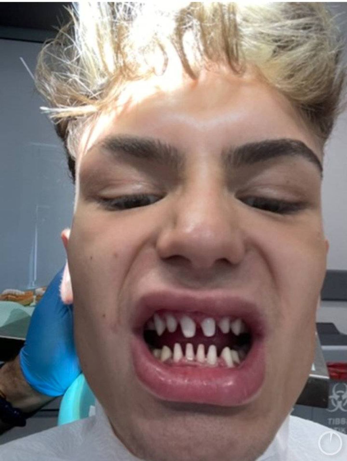 An individual with closed eyes appears to be undergoing a dental procedure, showcasing a close-up view of their mouth, possibly in a clinical setting.