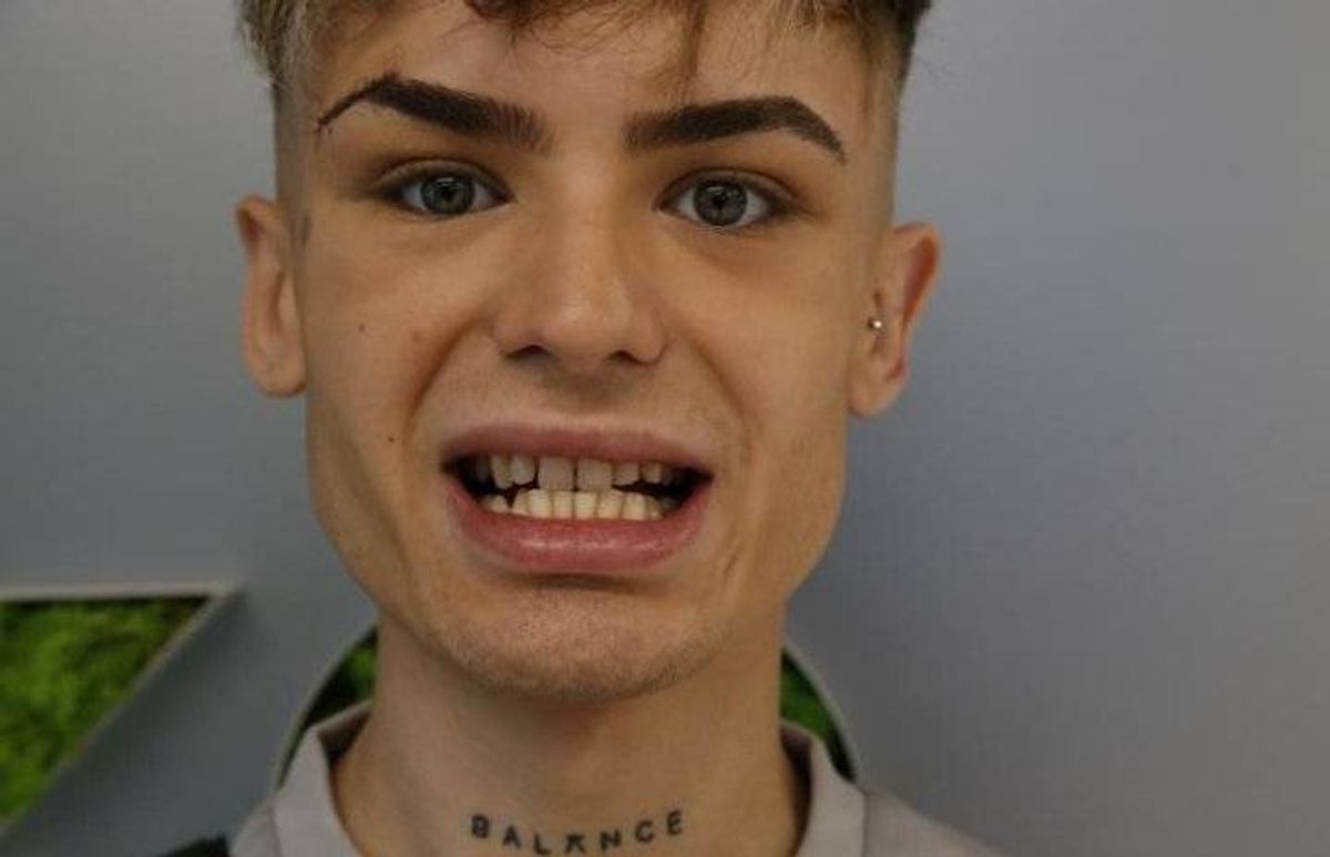 Jack James before getting his veneers