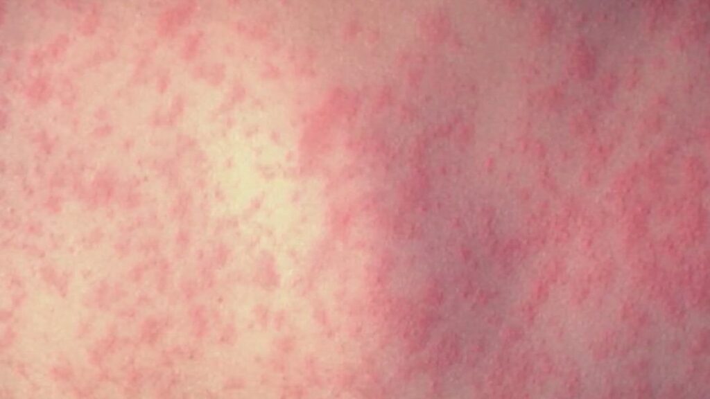 Health officials warn public after measles case in Broomfield