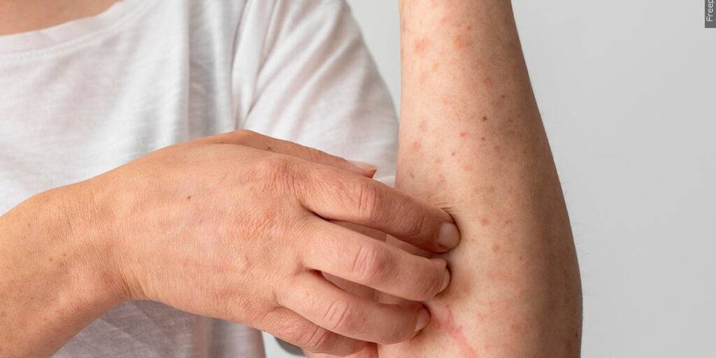 1st measles cases confirmed in Burke County, health officials say