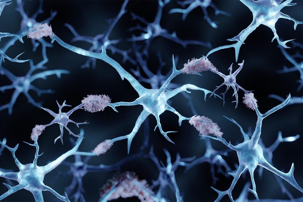 Scientists engineered CAR-T cell immunotherapy to target plaques of a key Alzheimer’s-causing protein in the brain called amyloid beta. In mice, they found that the engineered cells reduced the harmful amyloid plaques and improved the overall health of the brain tissue.