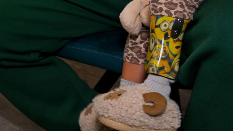 Liza's left leg was amputated after she was hit by shrapnel