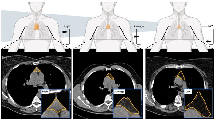 Illustrations of high, average or low thymic health and corresponding CT scans