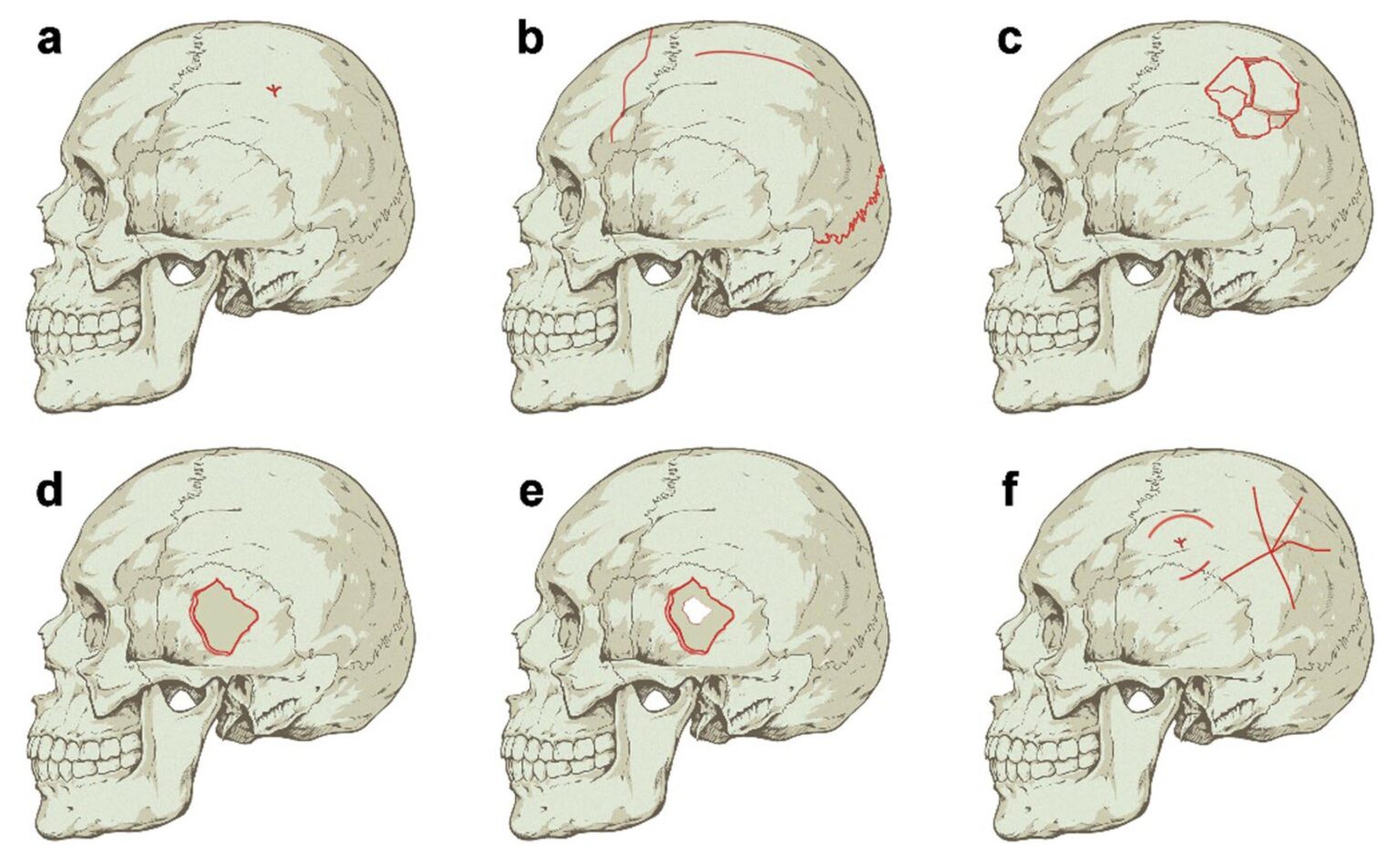Reading fossil skull fracture patterns: Biomechanical analysis provides new insights