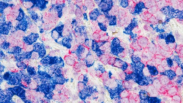 Study Finds Weakness in Triple Negative Breast Cancer Cells