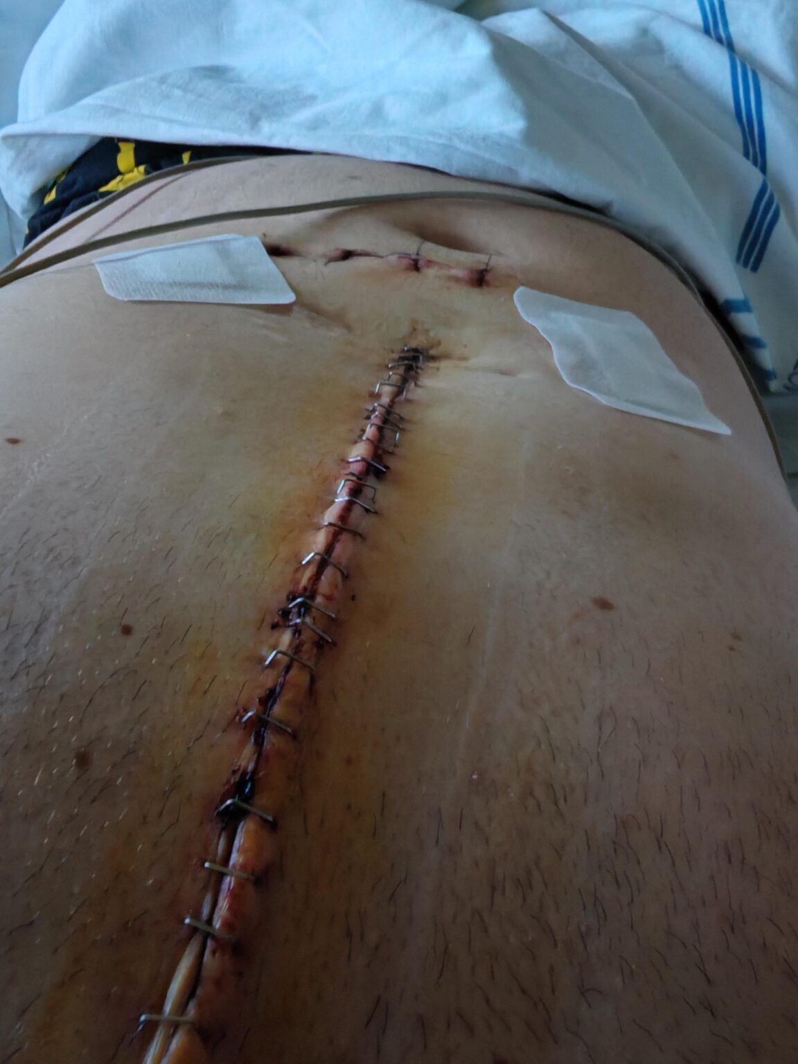 I'm in bed on the fifth day after heart surgery...