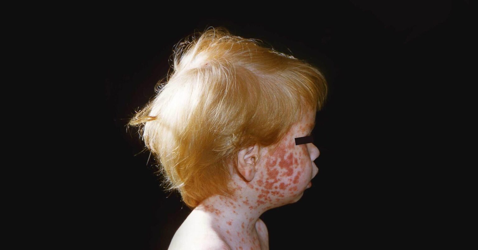 How Robert F. Kennedy Jr.’s Vaccine Agenda Risks a Resurgence of Deadly Childhood Plagues