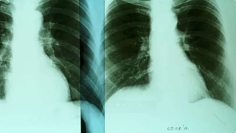 "Air pollution is a direct cause of lung cancer", says Senka Balorda.