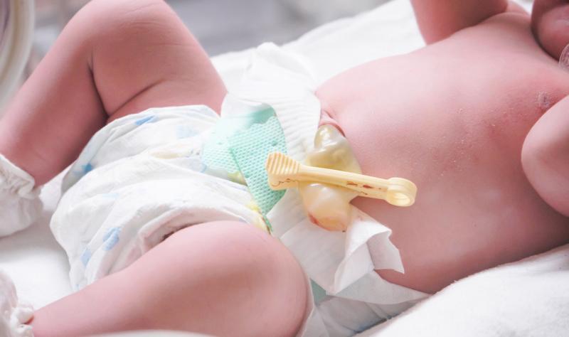 Antiseptic umbilical cord care reduces infection risk in low-income settings, review suggests