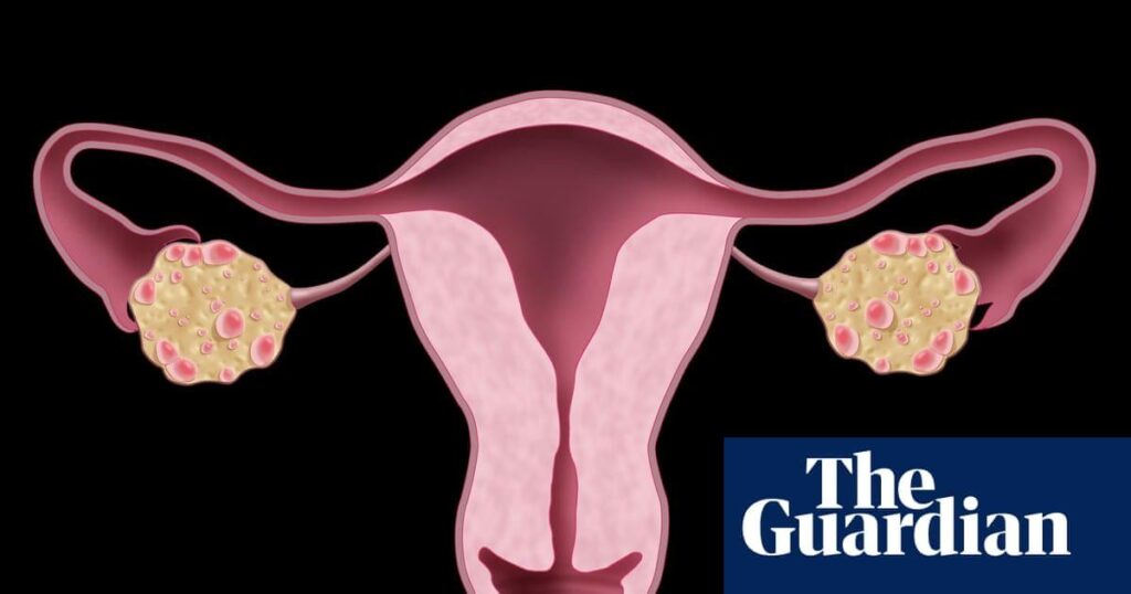 NHS urged to update website after renaming polycystic ovary syndrome NHS urged to update website after renaming polycystic ovary syndrome