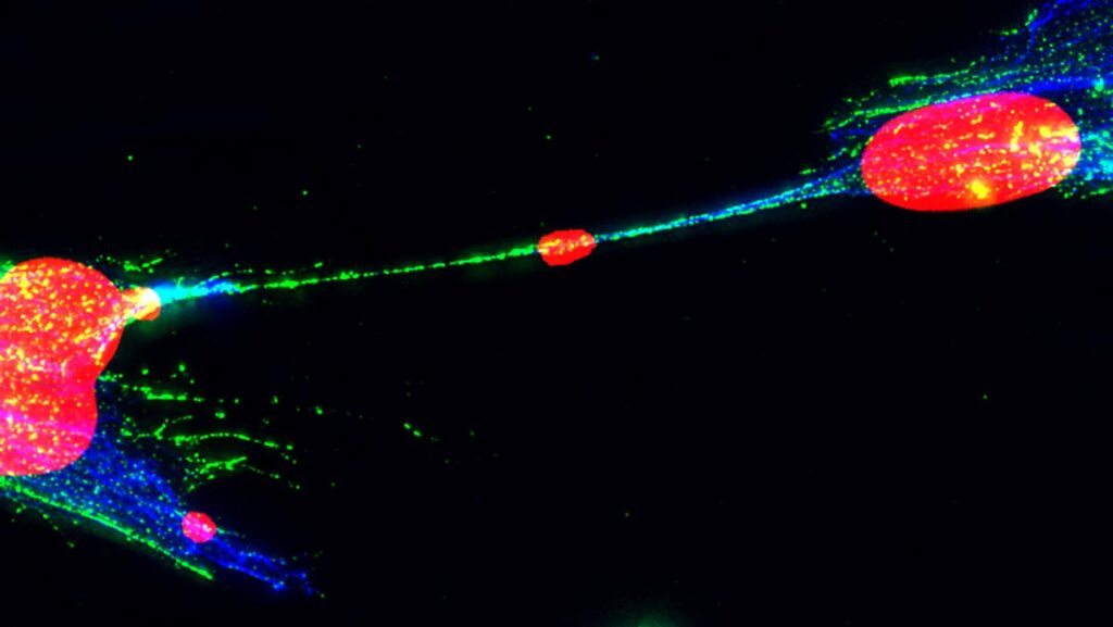 Damaged DNA can spread between human cells via tubelike structures. If tumors use this DNA transfer trick, harmful mutations could potentially spread from cancer cells to healthy cells. Damaged DNA can spread between human cells via tubelike structures. If tumors use this DNA transfer trick, harmful mutations could potentially spread from cancer cells to healthy cells.