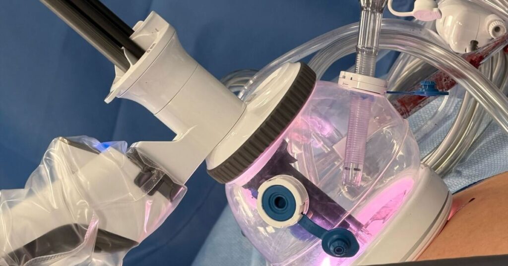 ECU Health has performed a North Carolina first: a new type of colorectal robotic surgery ECU Health has performed a North Carolina first: a new type of colorectal robotic surgery