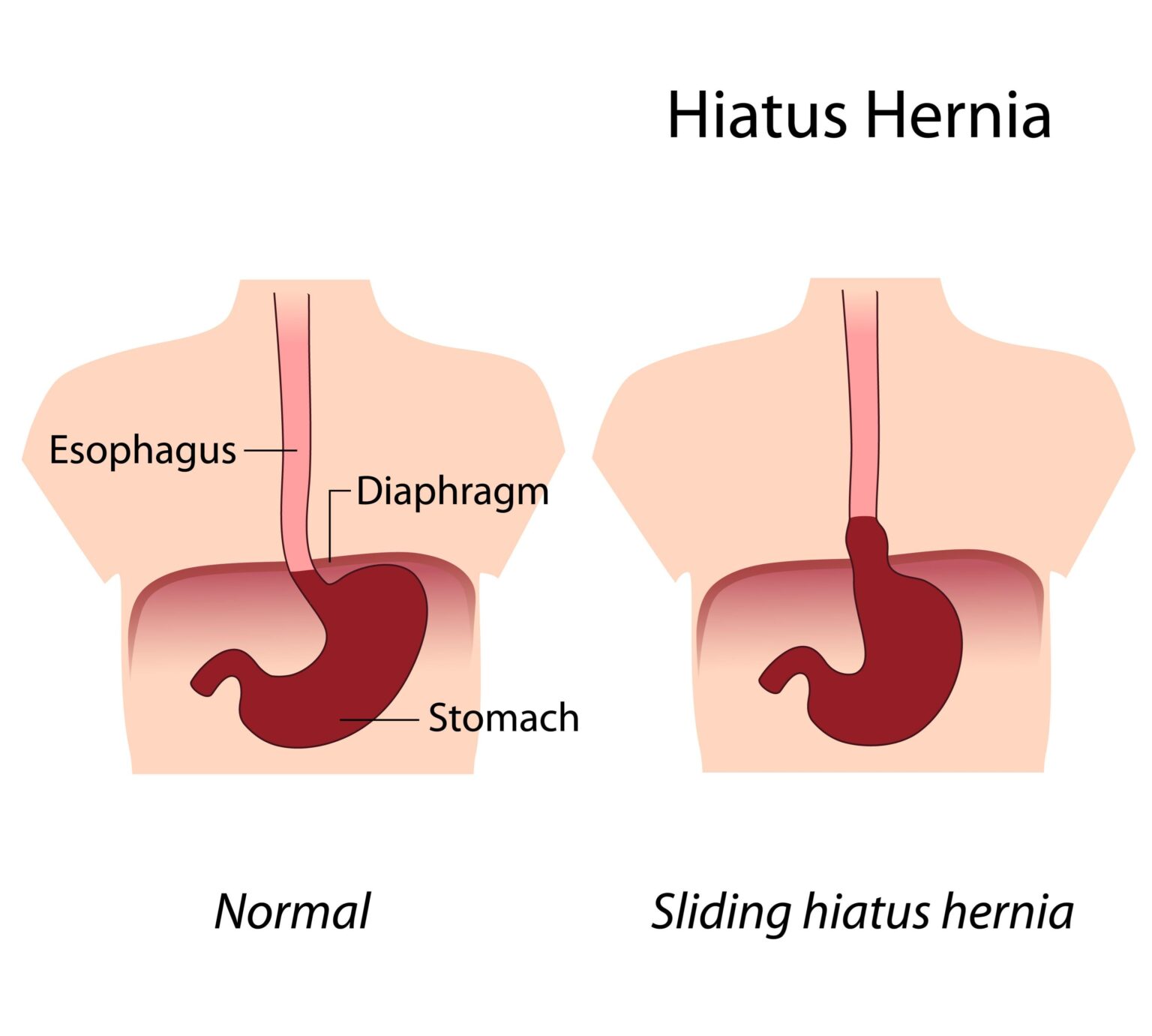 Reflux, sliding hiatal hernia Reflux, sliding hiatal hernia