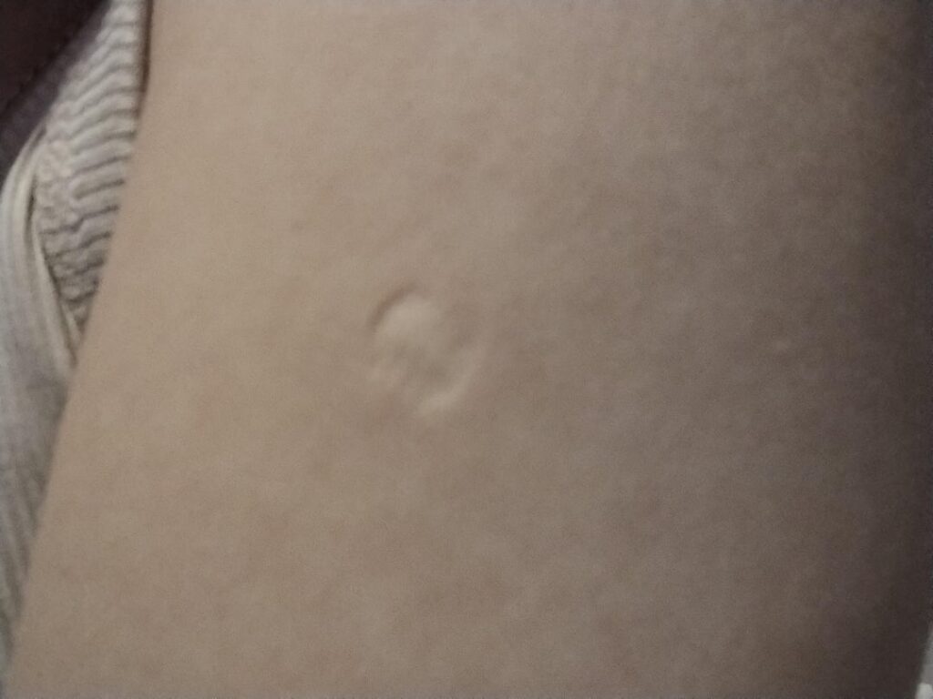 “Not the vaccine!” How many scars do you have? "Not the vaccine!" How many scars do you have?