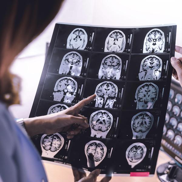 Researchers have developed an AI tool called AIDD that distinguishes between Alzheimer’s disease and dementia with Lewy bodies with near-perfect accuracy. Alzheimer’s disease and related dementias are expected to more than double by 2060