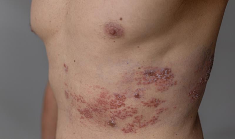 Shingles vaccine may protect against dementia