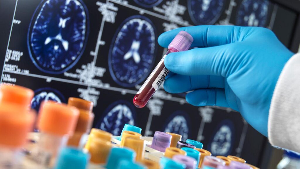 A blood test for dementia may tell you if you have more than one type | The test can help diagnose four neurodegenerative diseases — Alzheimer’s, Parkinson’s, frontotemporal dementia and dementia with Lewy bodies — based on levels of 15 proteins in the blood. A blood test for dementia may tell you if you have more than one type | The test can help diagnose four neurodegenerative diseases — Alzheimer's, Parkinson's, frontotemporal dementia and dementia with Lewy bodies — based on levels of 15 proteins in the blood.