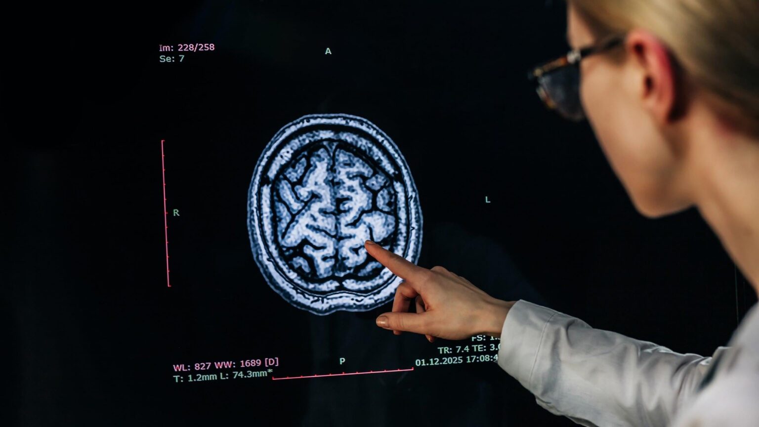 A new study shows that even a small reduction in systolic blood pressure can help slow down the progression of cerebral small vessel disease, reducing the risk of cognitive decline and dementia.